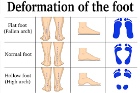 Lack of Arch Support and Stability