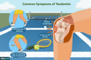 Tendinitis Concerns