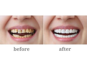 Why Choose Porcelain Crowns for Front Teeth?